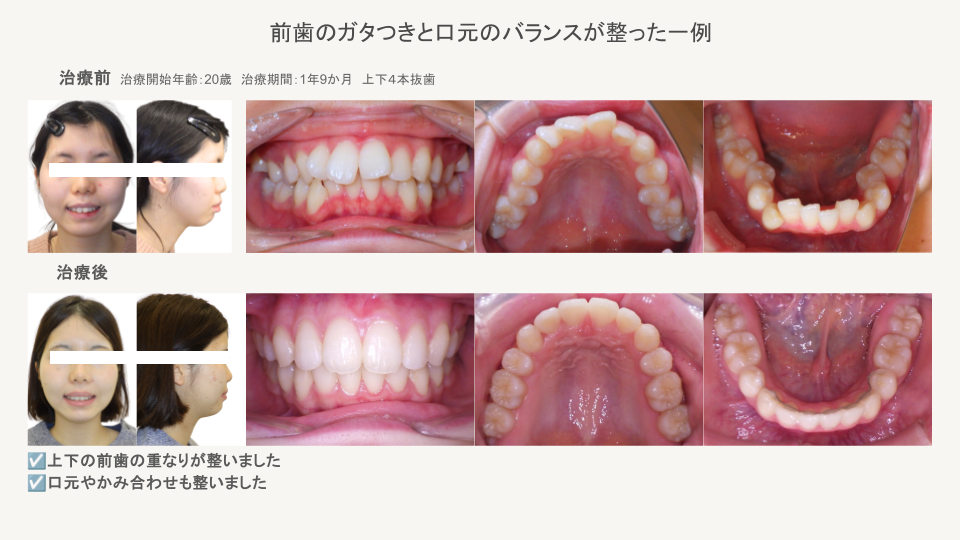 前歯のガタつきと口元のバランスが整った症例