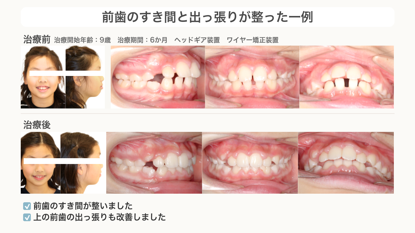 前歯のすき間と出っ張りが整った出っ歯の症例