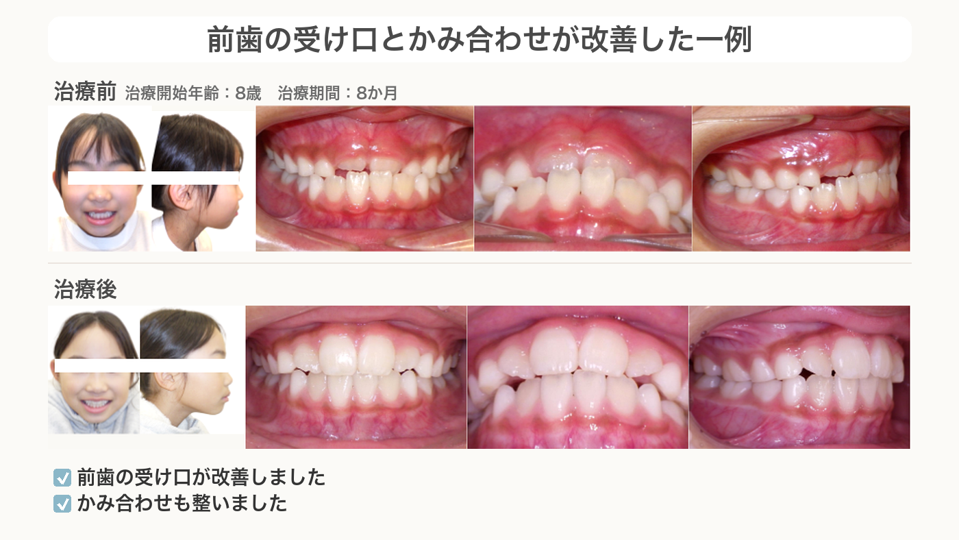 前歯の受け口とかみ合わせが改善した受け口の症例