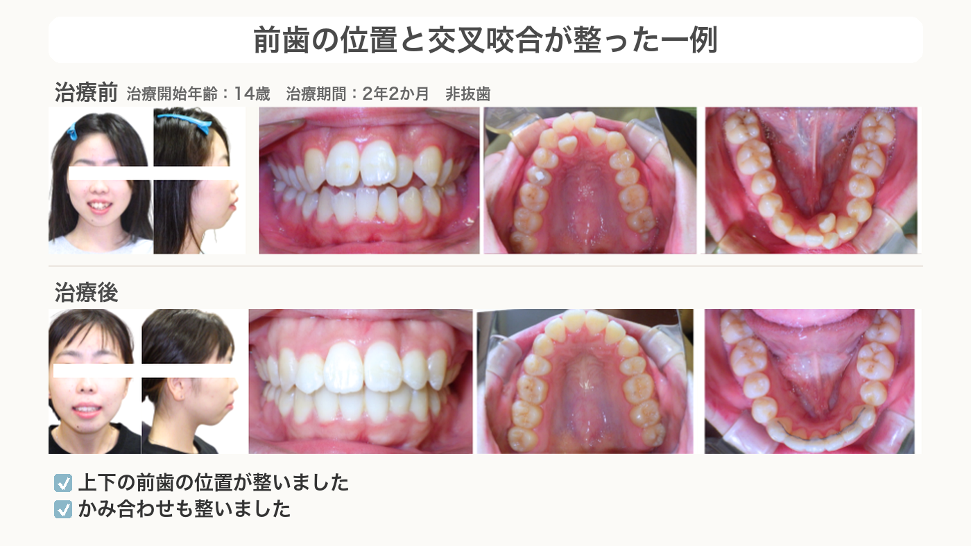 前歯の位置と交叉咬合が整った口が閉じない症例
