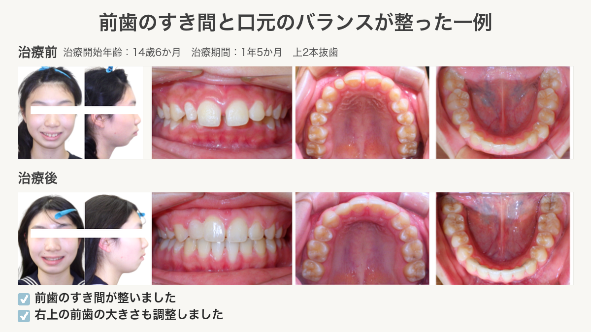 前歯のすき間と口元のバランスが整った深い噛み合わせの症例