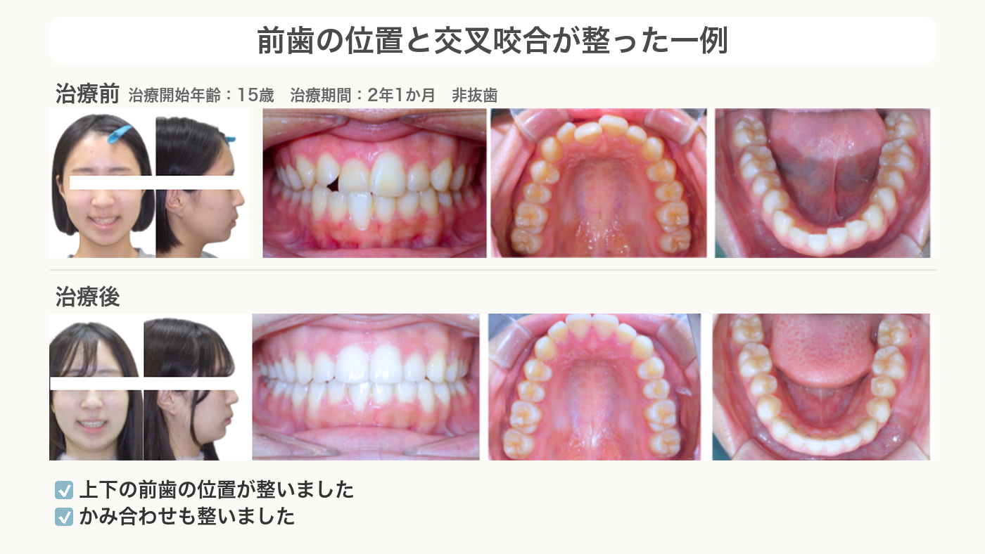 前歯の位置と交叉咬合が整った交叉咬合の症例