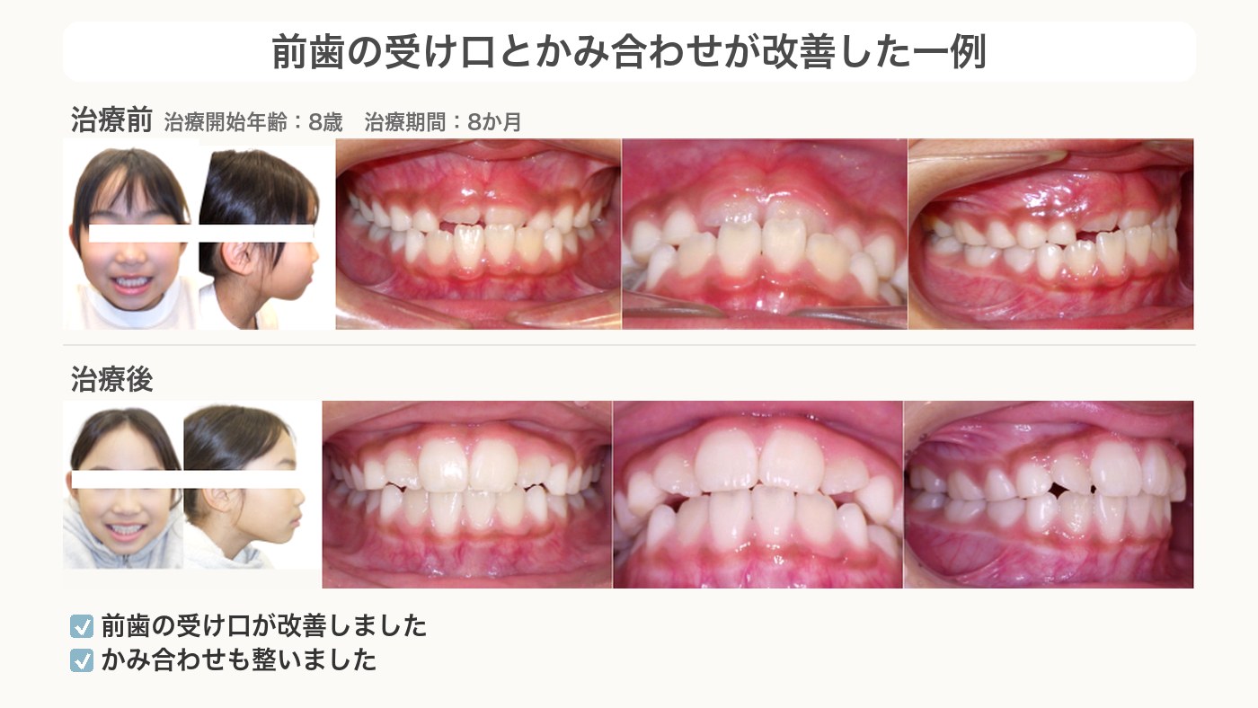 前歯の受け口とかみ合わせが改善したこどもの歯並び治療症例